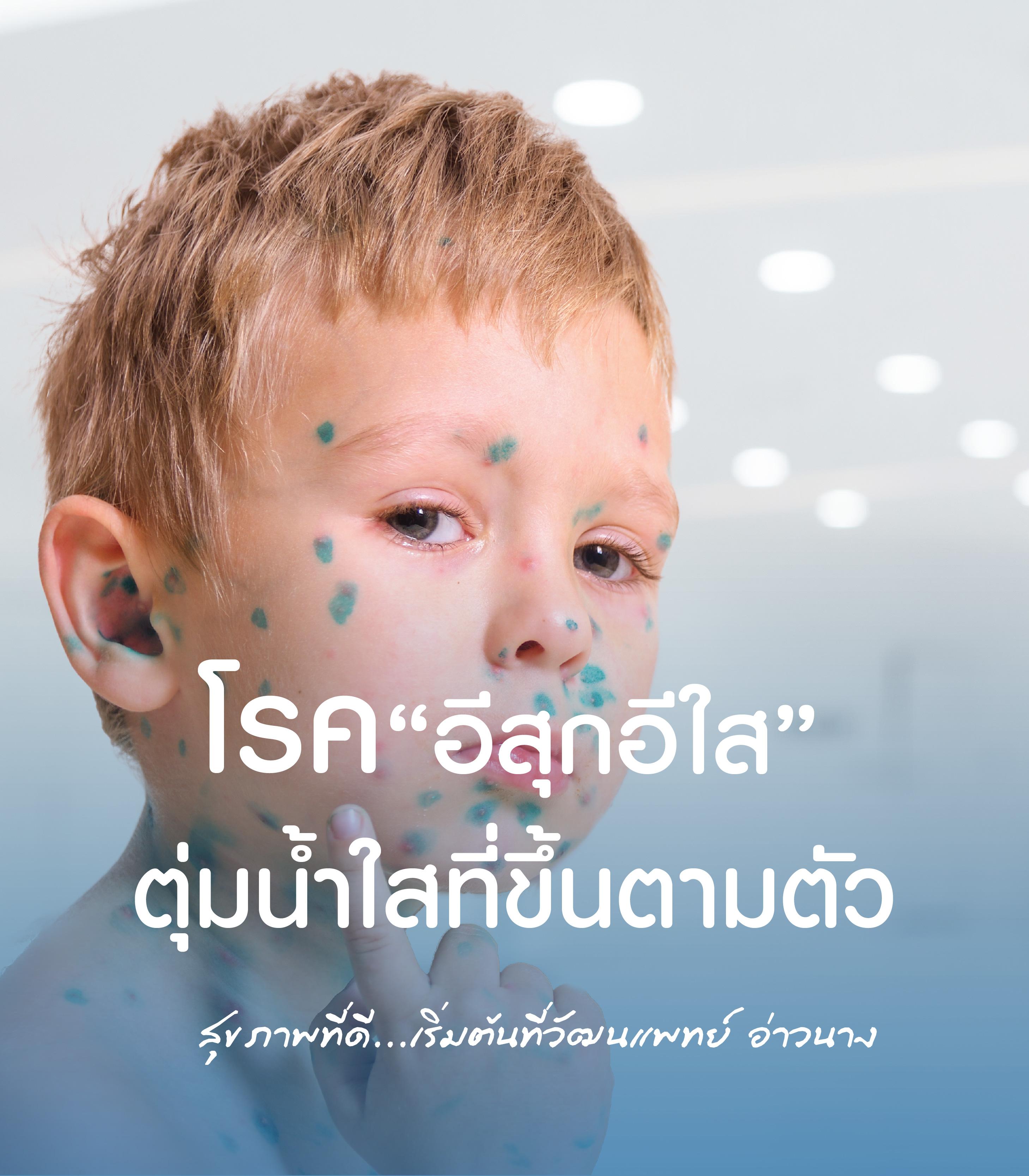 โรคอีสุกอีใส