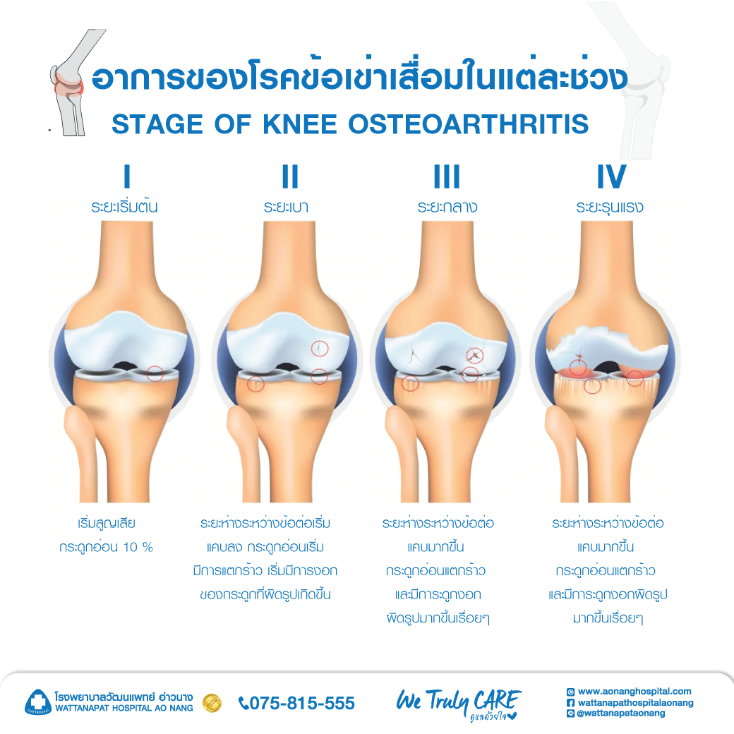 Stage Of Knee Osteoarthritis
